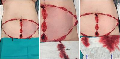 Use of the superficial inferior epigastric vein in breast reconstruction with a deep inferior epigastric artery perforator flap